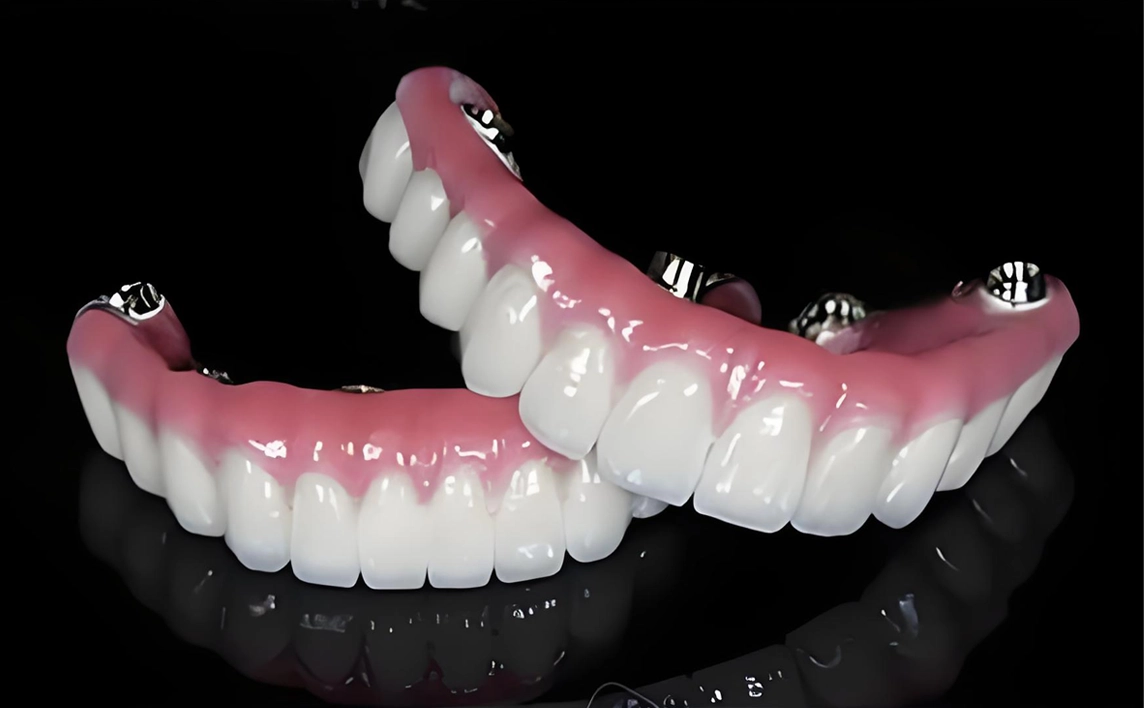 Dental Implants